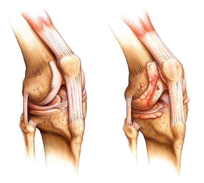 Articulație sănătoasă (stânga) și articulație artritică (dreapta)