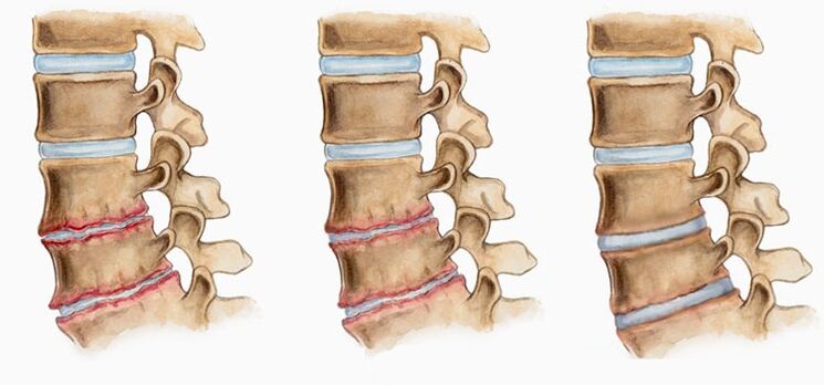 Deformarea discurilor intervertebrale în osteocondroză poate provoca dureri de spate