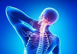 osteochondroză - o boală a coloanei vertebrale