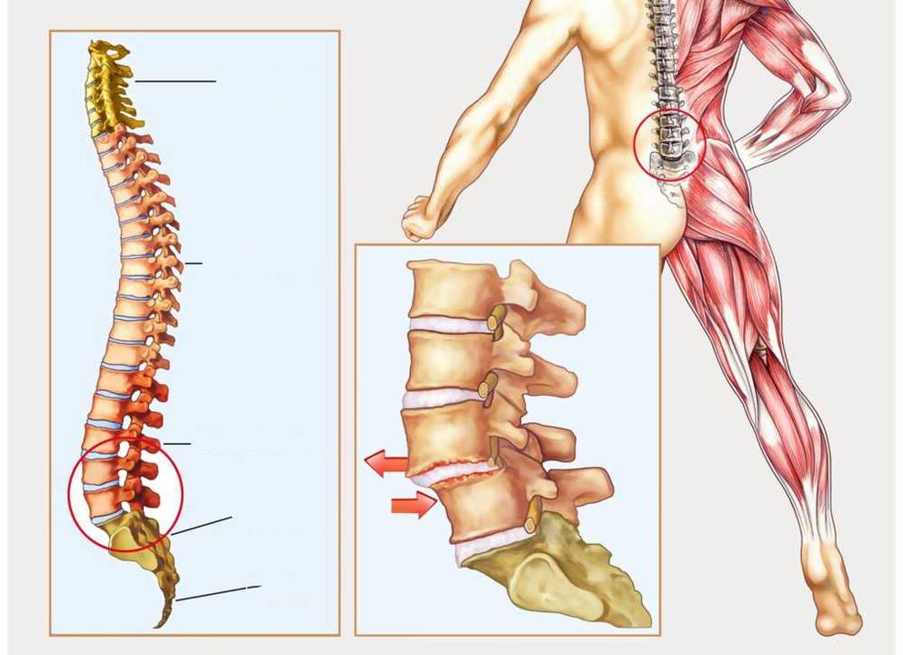coloana vertebrala sanatoasa si bolnava
