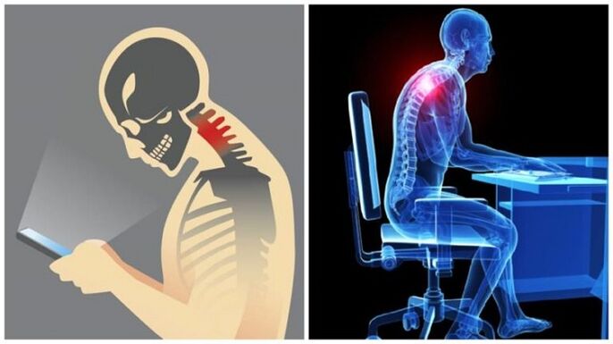 munca sedentară și înclinarea ca motive ale dezvoltării osteocondrozei