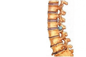 modificări ale coloanei vertebrale în diferite stadii de dezvoltare a osteocondrozei cervicale